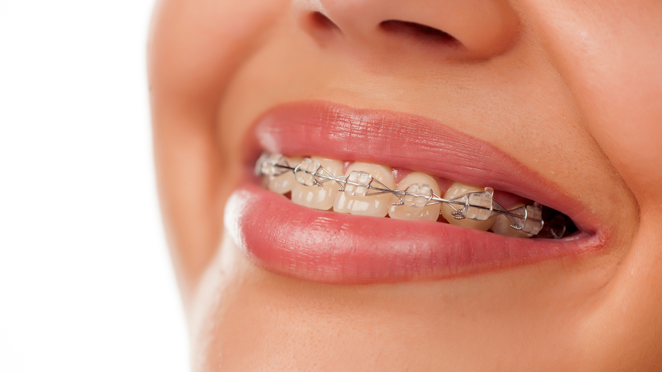 If You Don't Want Traditional Metal Braces, What Are the Other Options?
