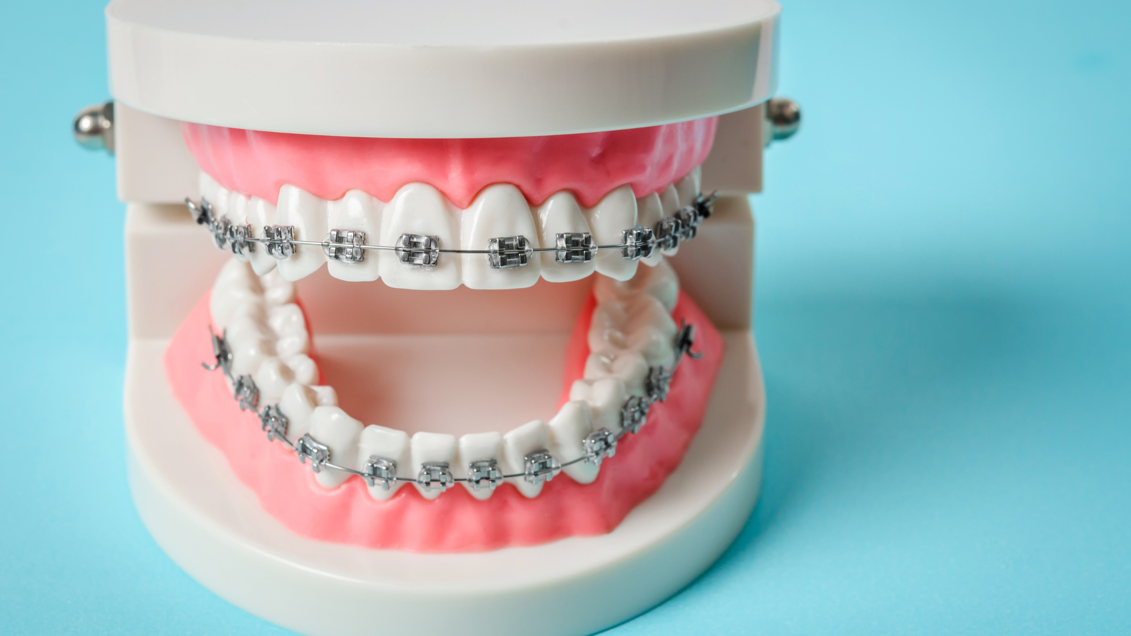Besides Straight Teeth, What are the Benefits of Braces?
