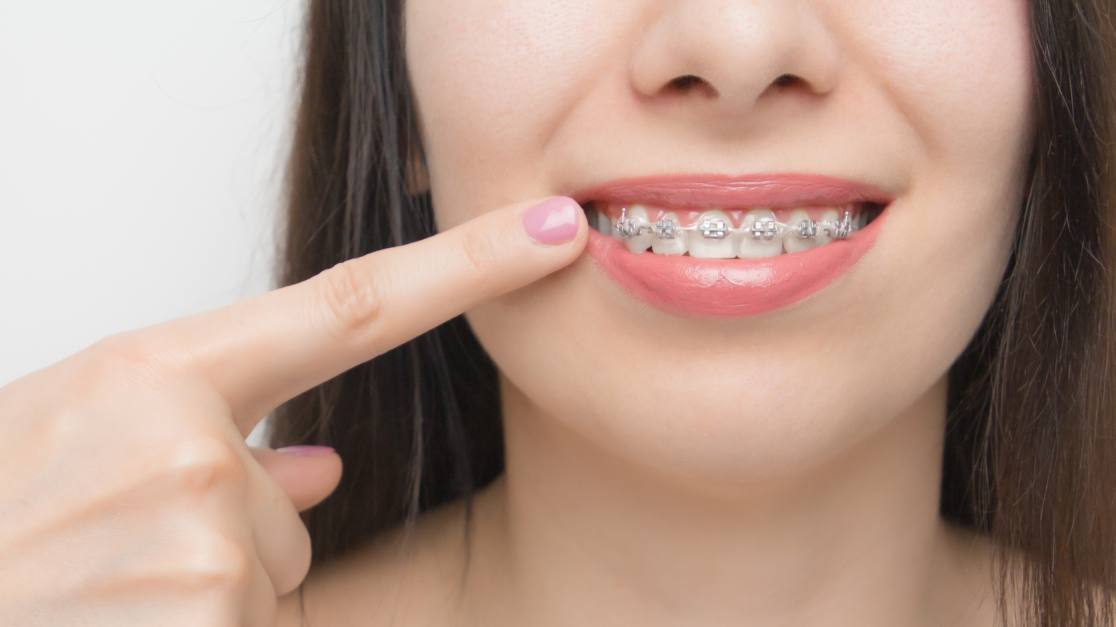 Understanding How Self-Ligating Braces Work