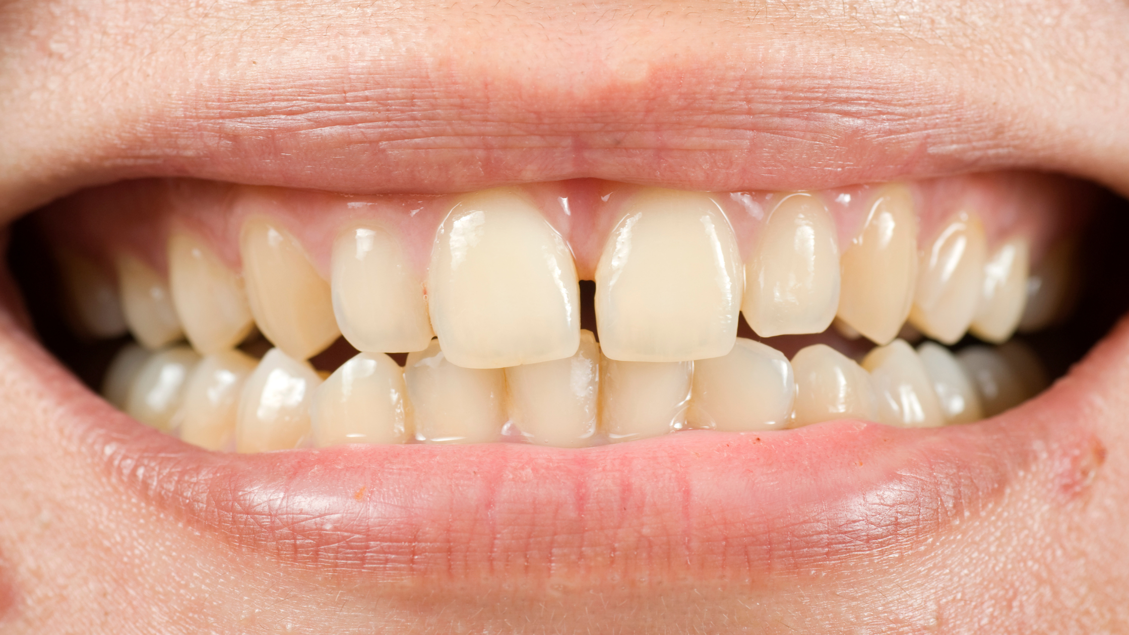 How Can Widely-Spaced Teeth Impact Your Overall Health
