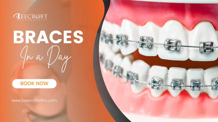 Braces in a Day