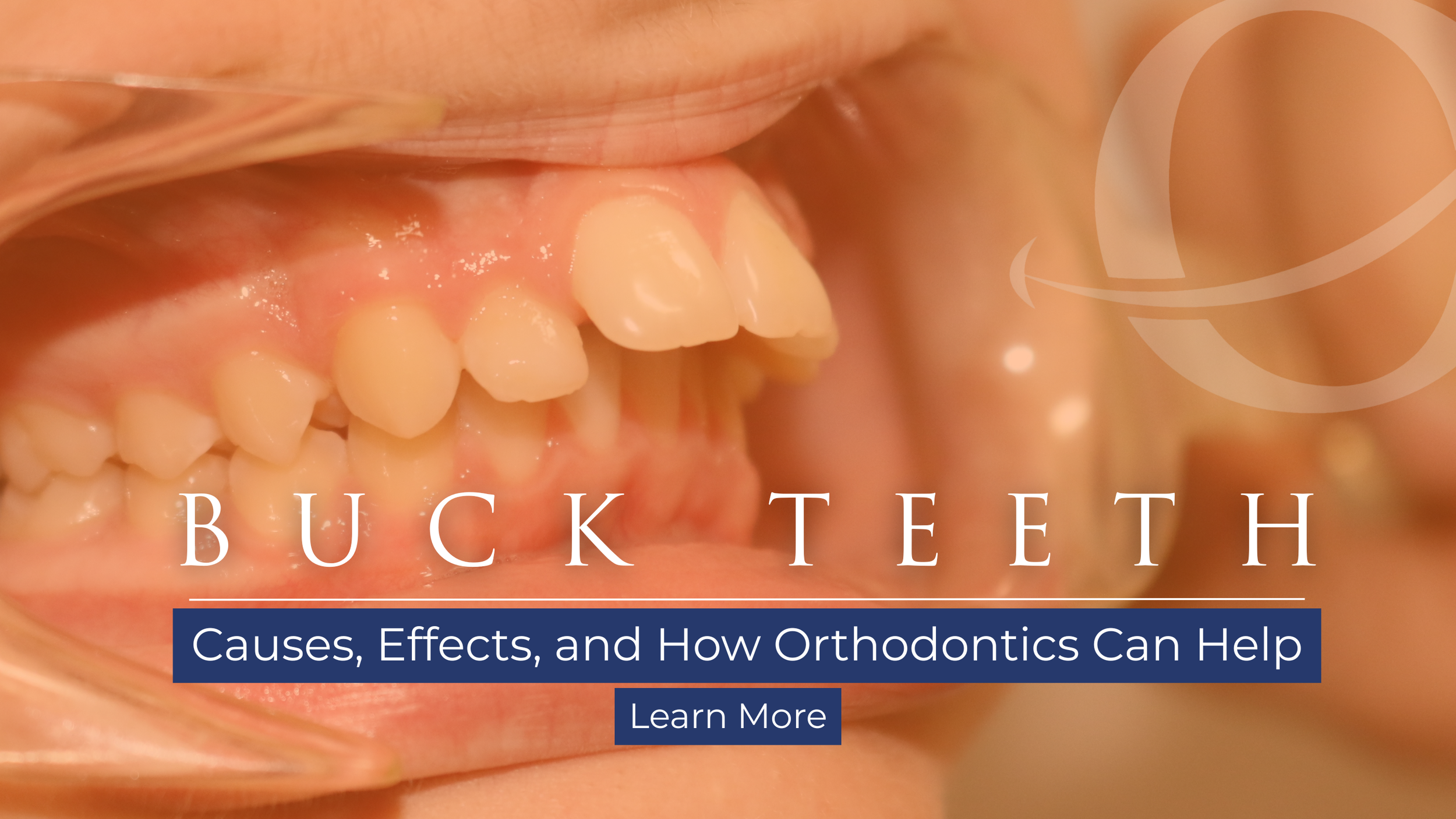 Buck Teeth: How Orthodontics Can Help You Achieve a Healthier Smile