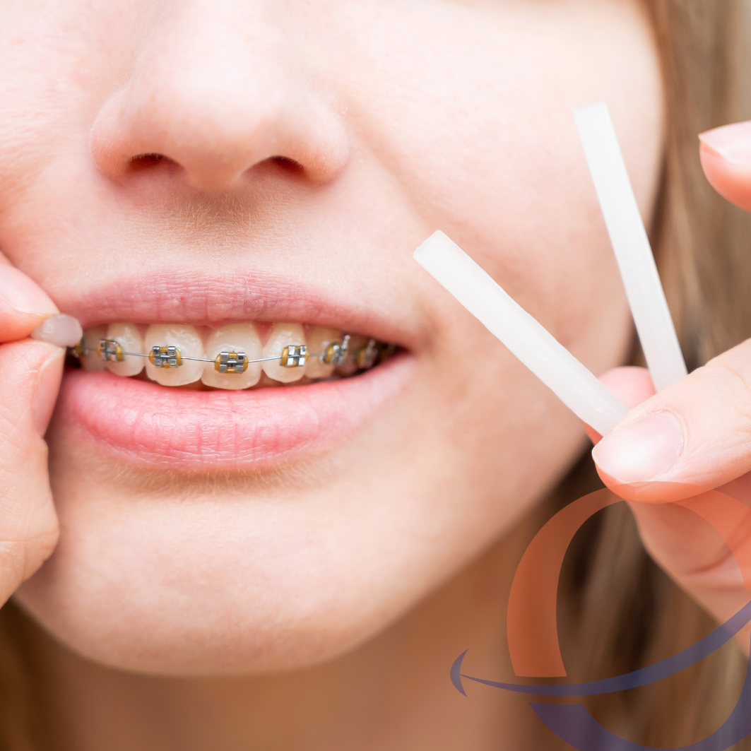Orthodontic Wax: Everything You Need to Know