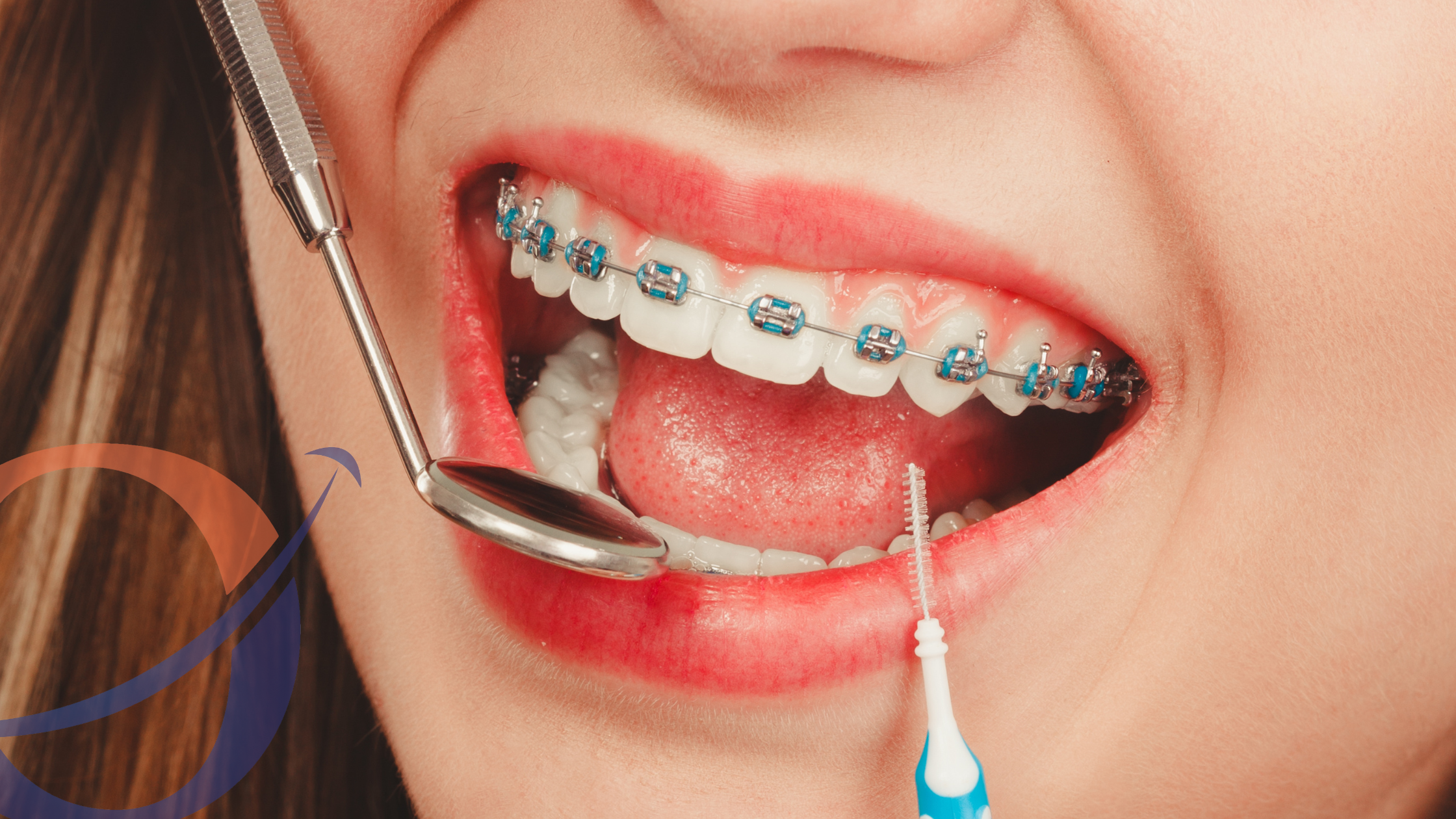 Do I Need Braces? Take This Orthodontic Quiz to Find Out