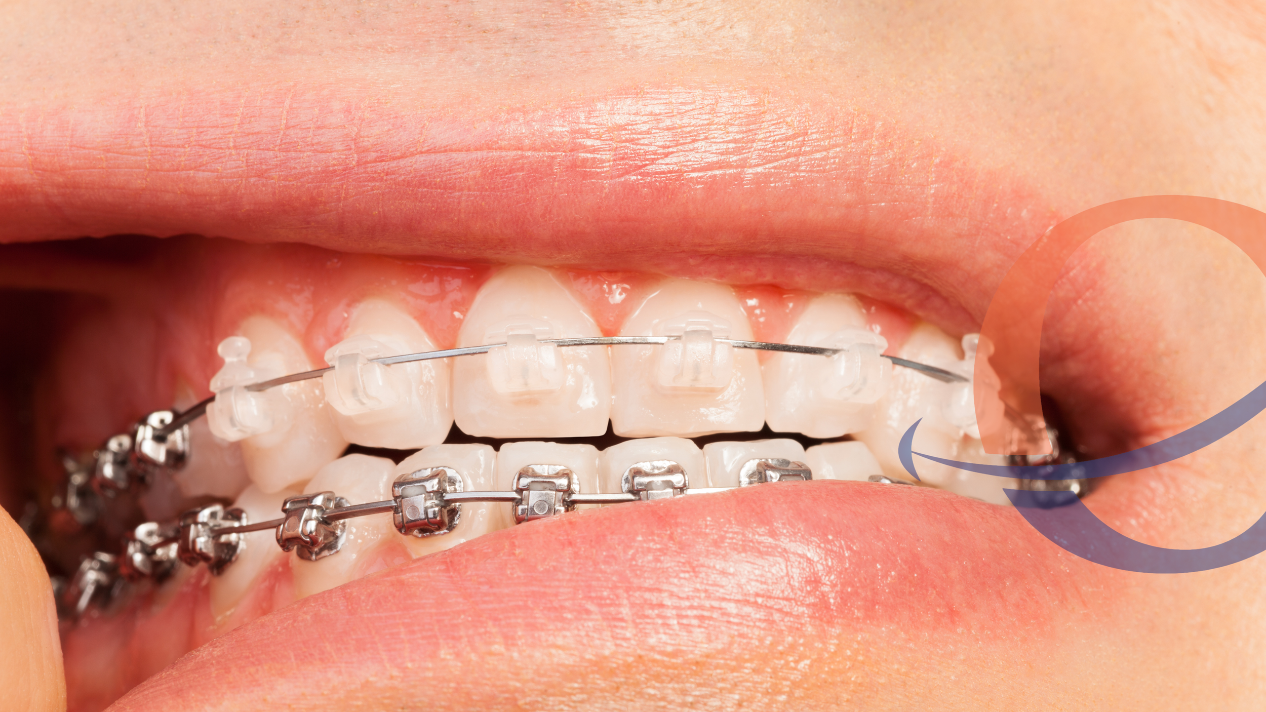 What Happens If You Don’t Fix Your Bite?