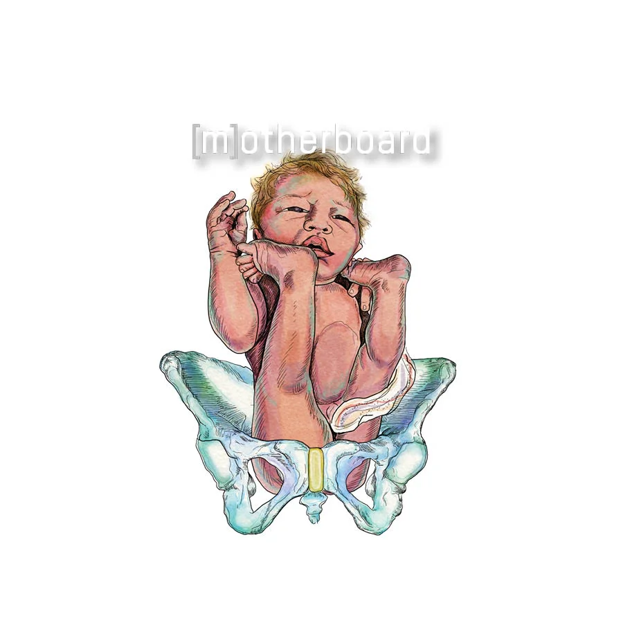 Breech Presentation — Motherboard Birth