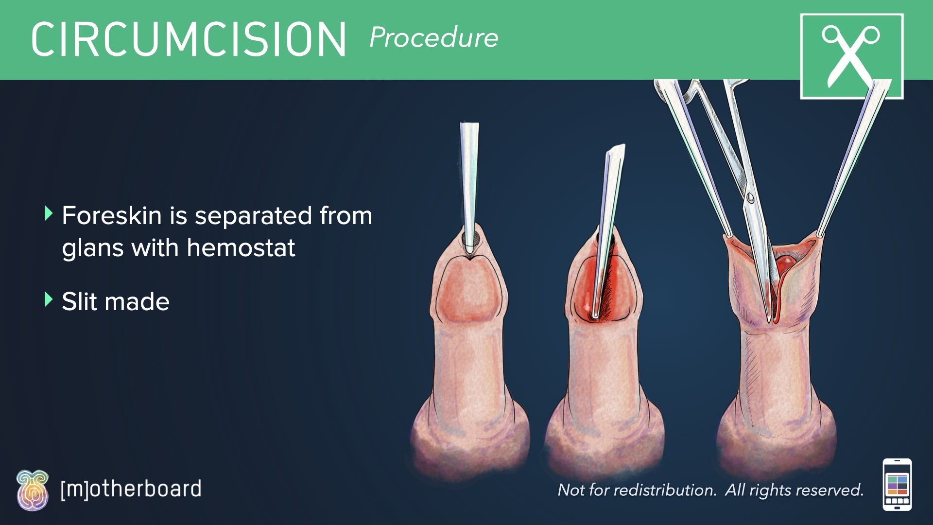 Circumcision Images.010.jpeg