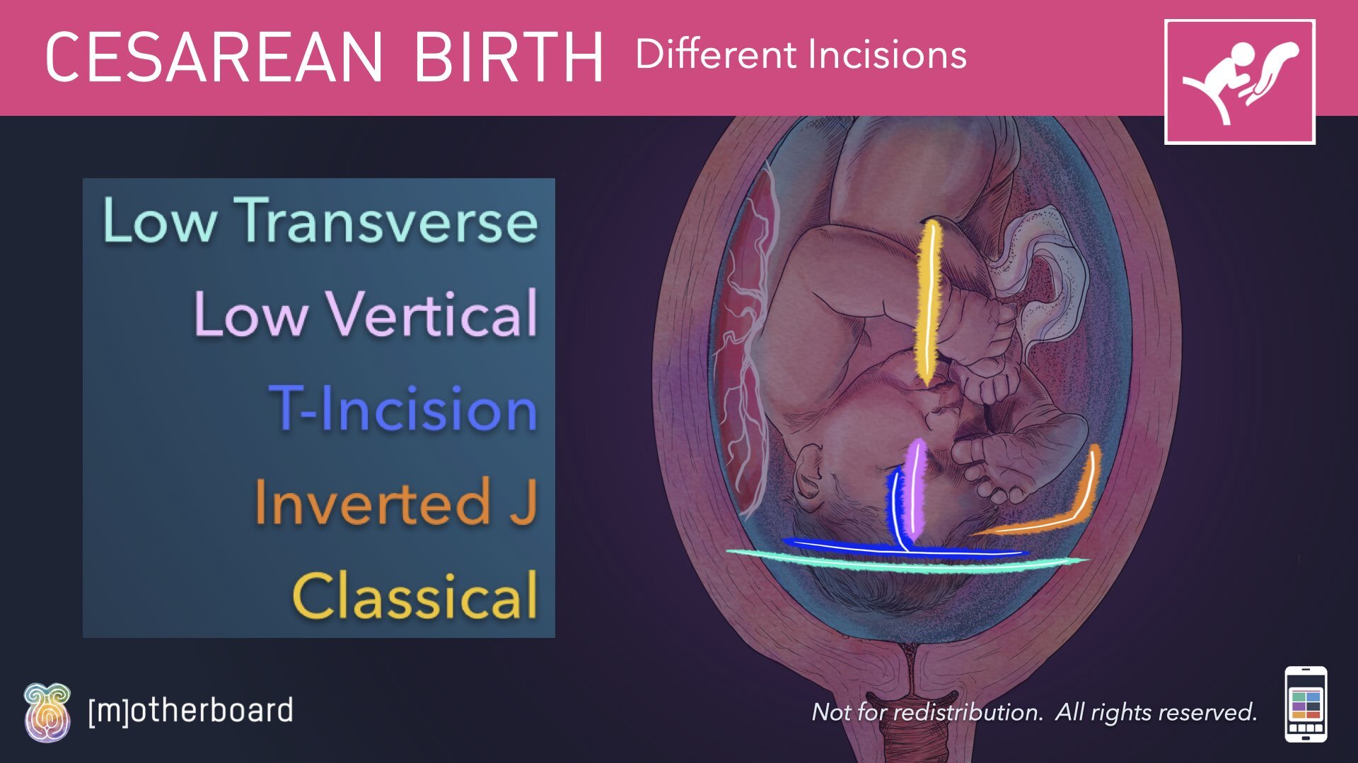 Cesarean Birth Images.008.jpeg