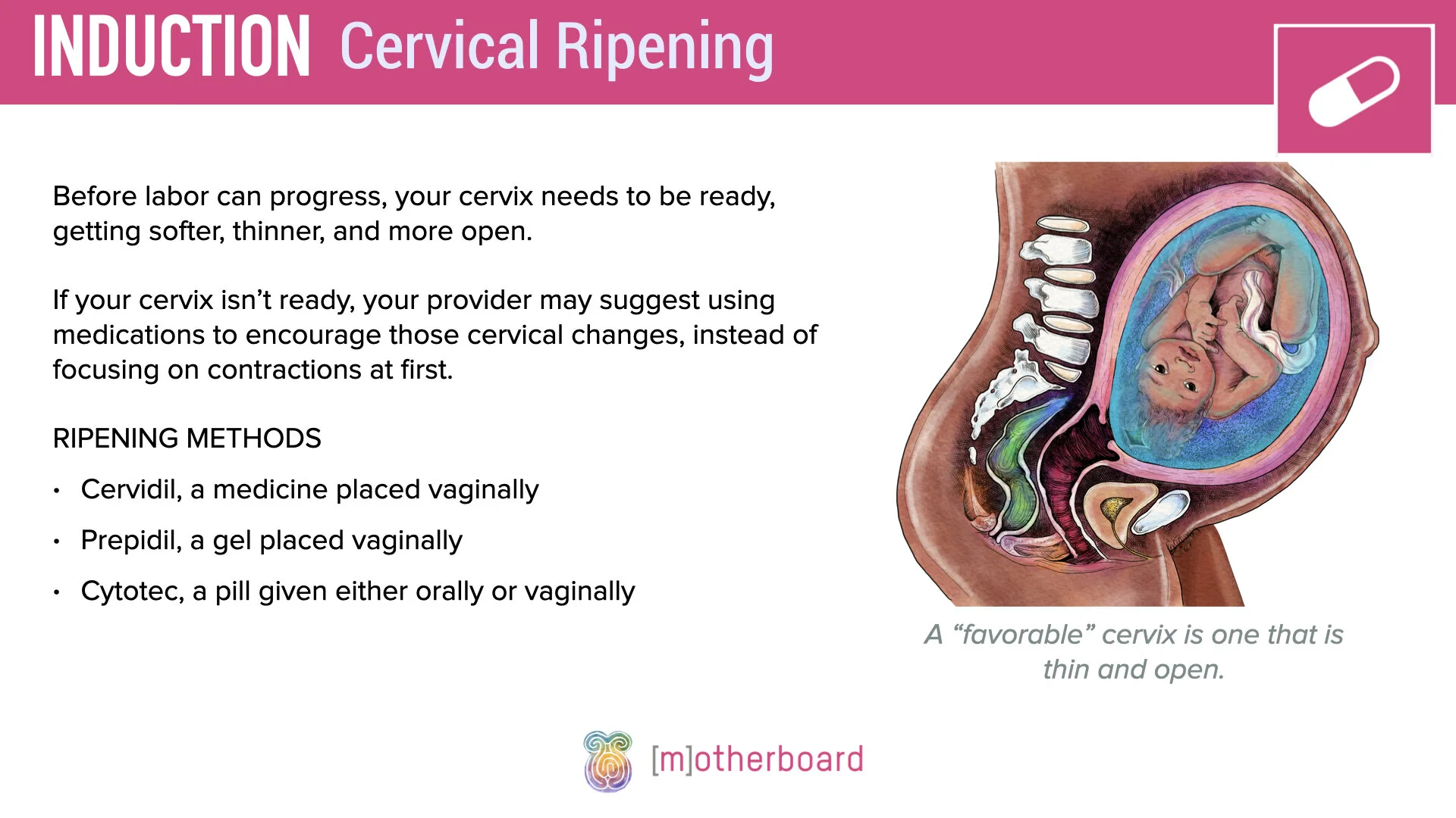 Induction - Cervical Ripening.002.jpeg