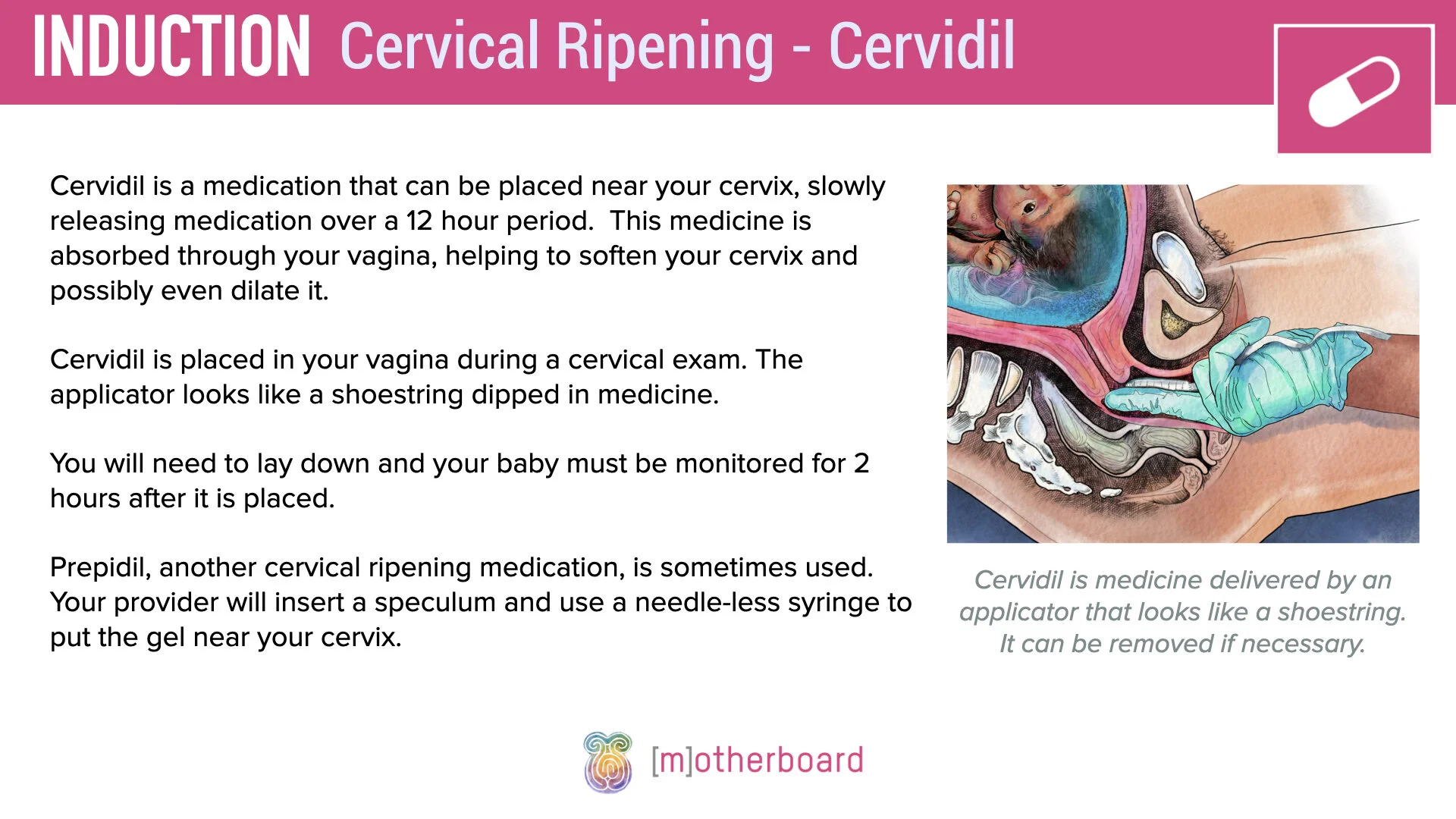 Induction - Cervical Ripening.003.jpeg