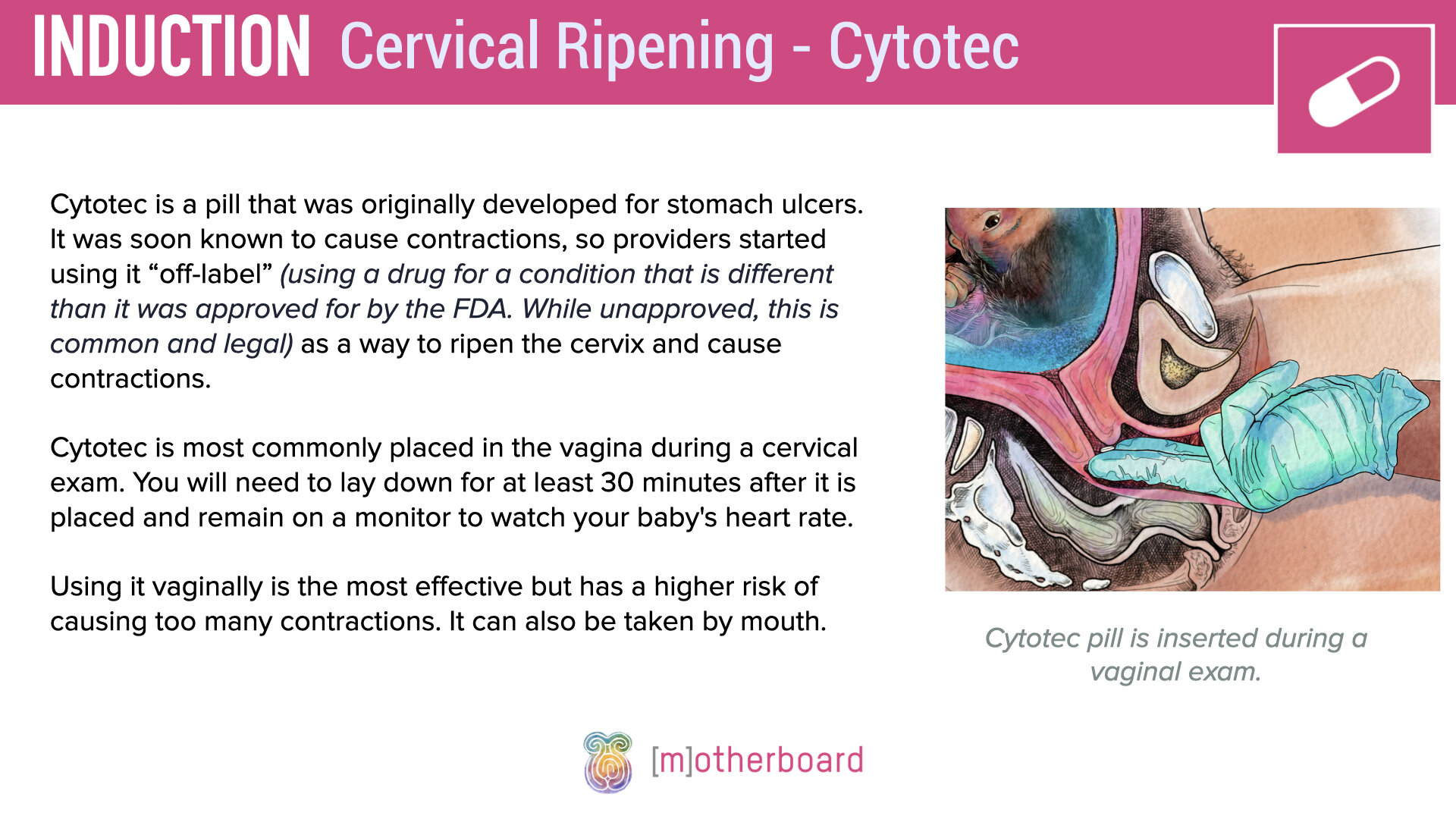 Induction - Cervical Ripening.005.jpeg