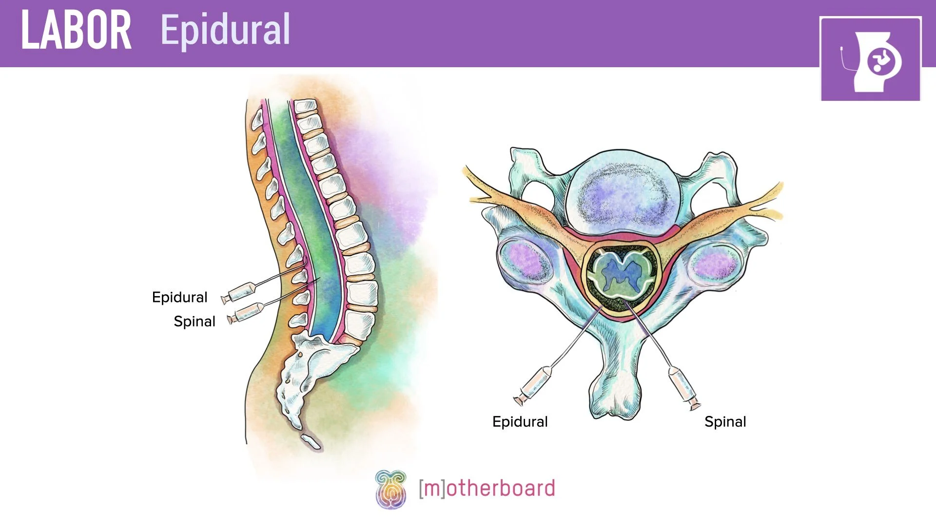 Labor - Pain Management - Epidural.002.jpeg