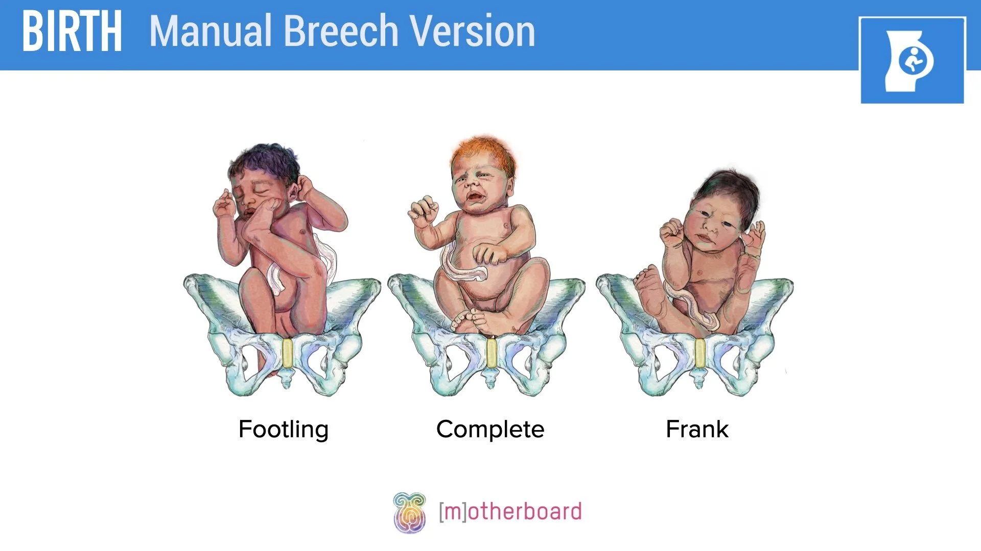 Birth - Breech Overview.003.jpeg