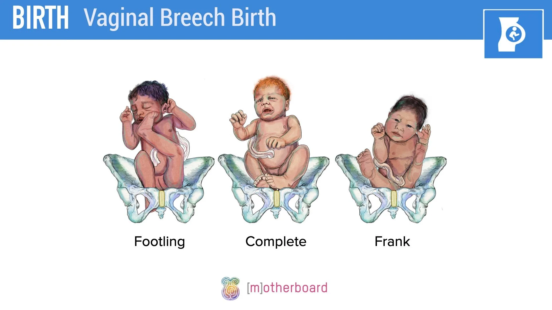 Birth - Breech - Vaginal Breech.002.jpeg