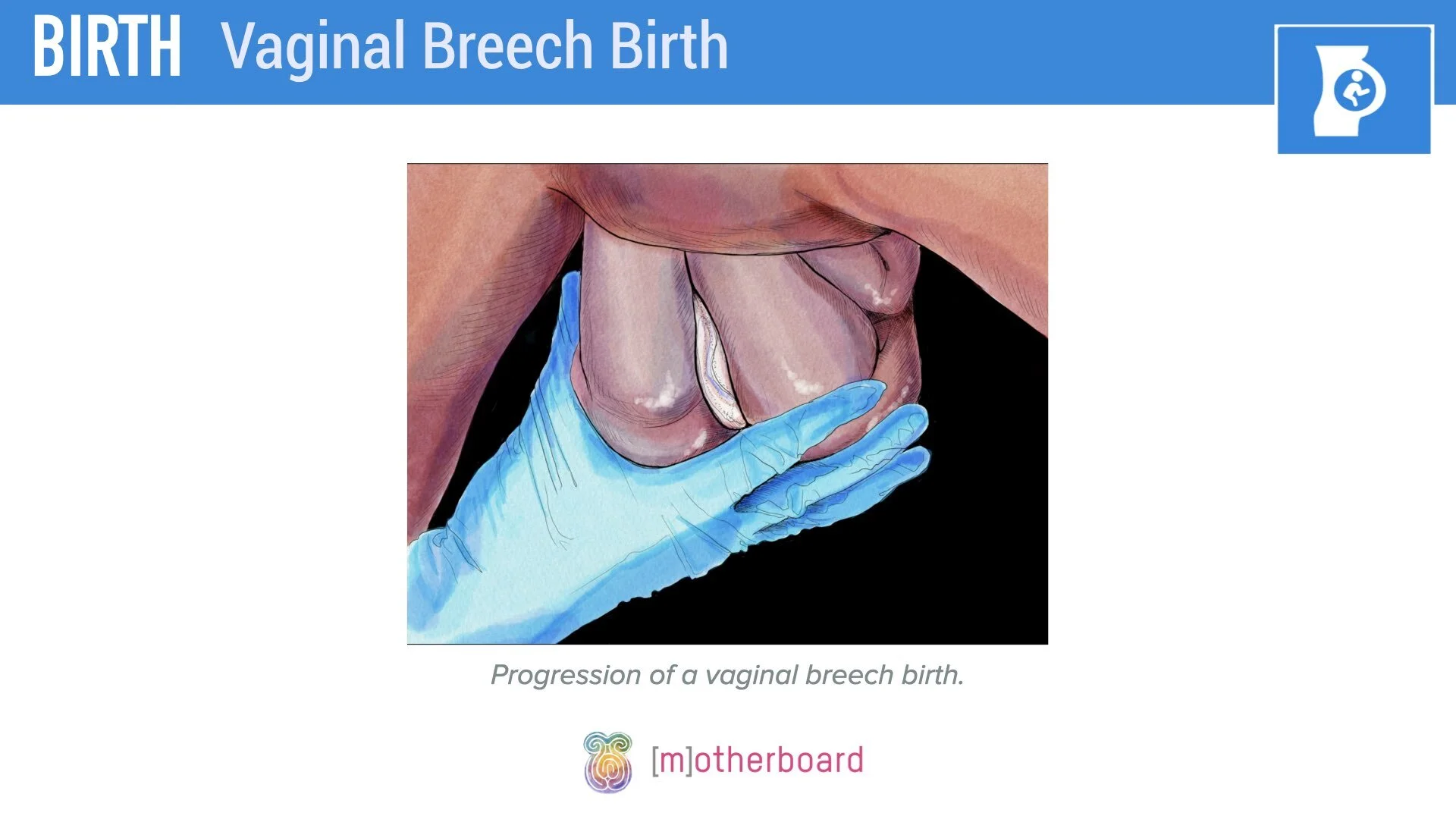 Birth - Breech - Vaginal Breech.004.jpeg