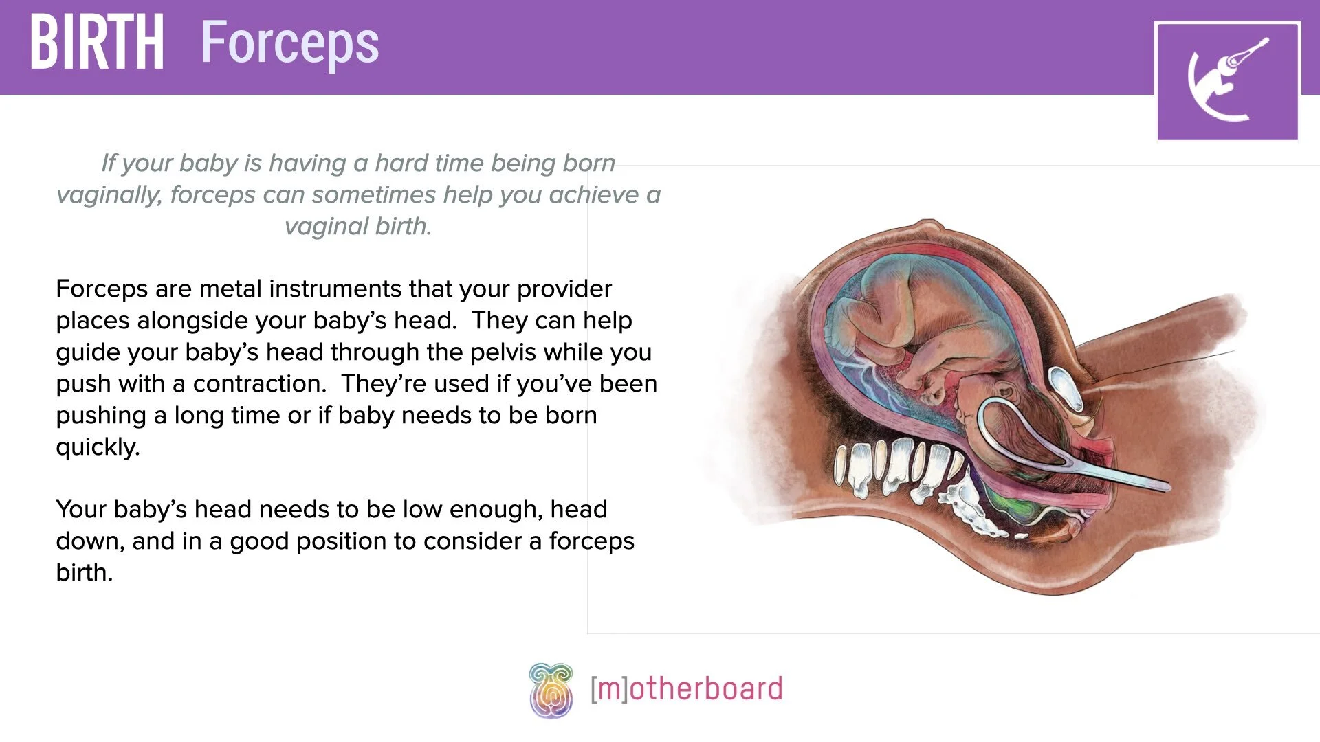 Birth - Assisted Birth - Forceps.001.jpeg