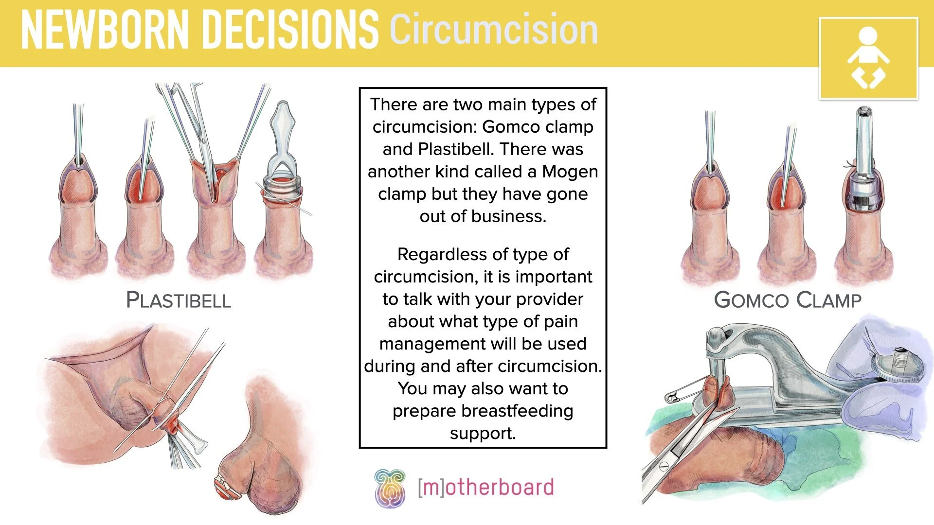 Postpartum - Newborn Decisions - Circumcisions.003.jpeg