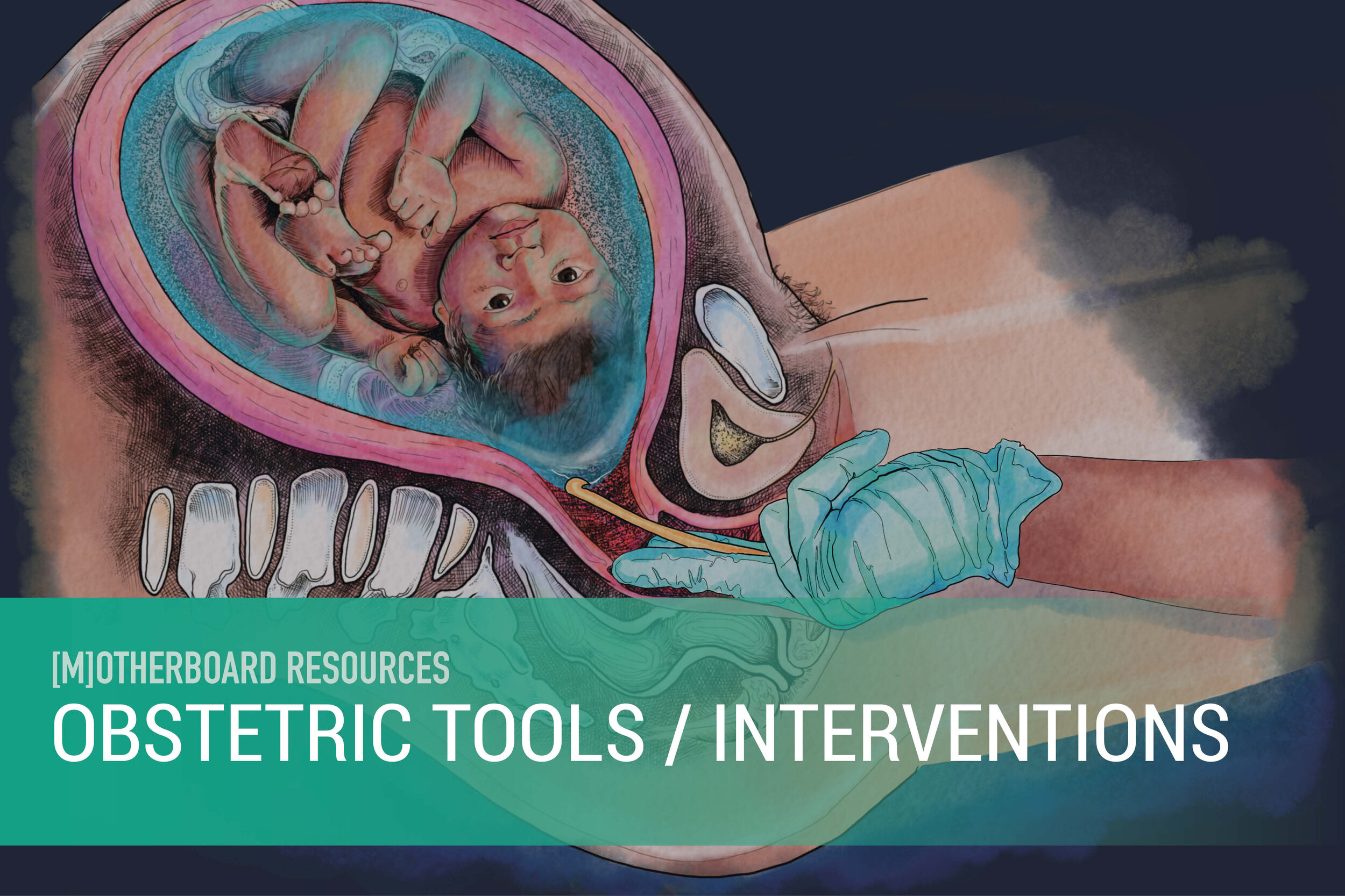 Obstetric Tools : Interventions.jpg