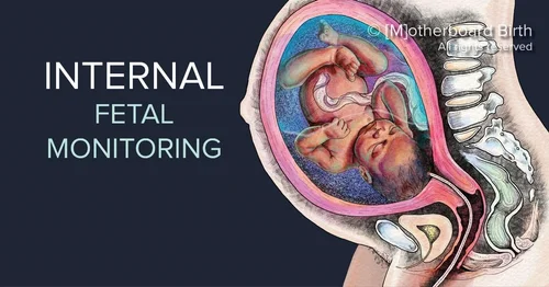 The Ultimate Guide: Understanding Artificial Rupture of Membranes (AROM ...