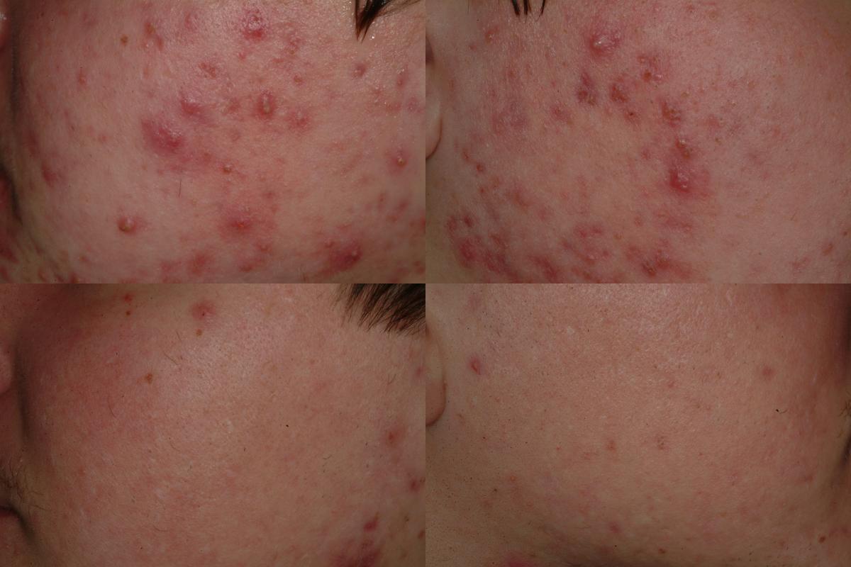 See our amazing results in this patient's image from a recent PLDI clinical trial!