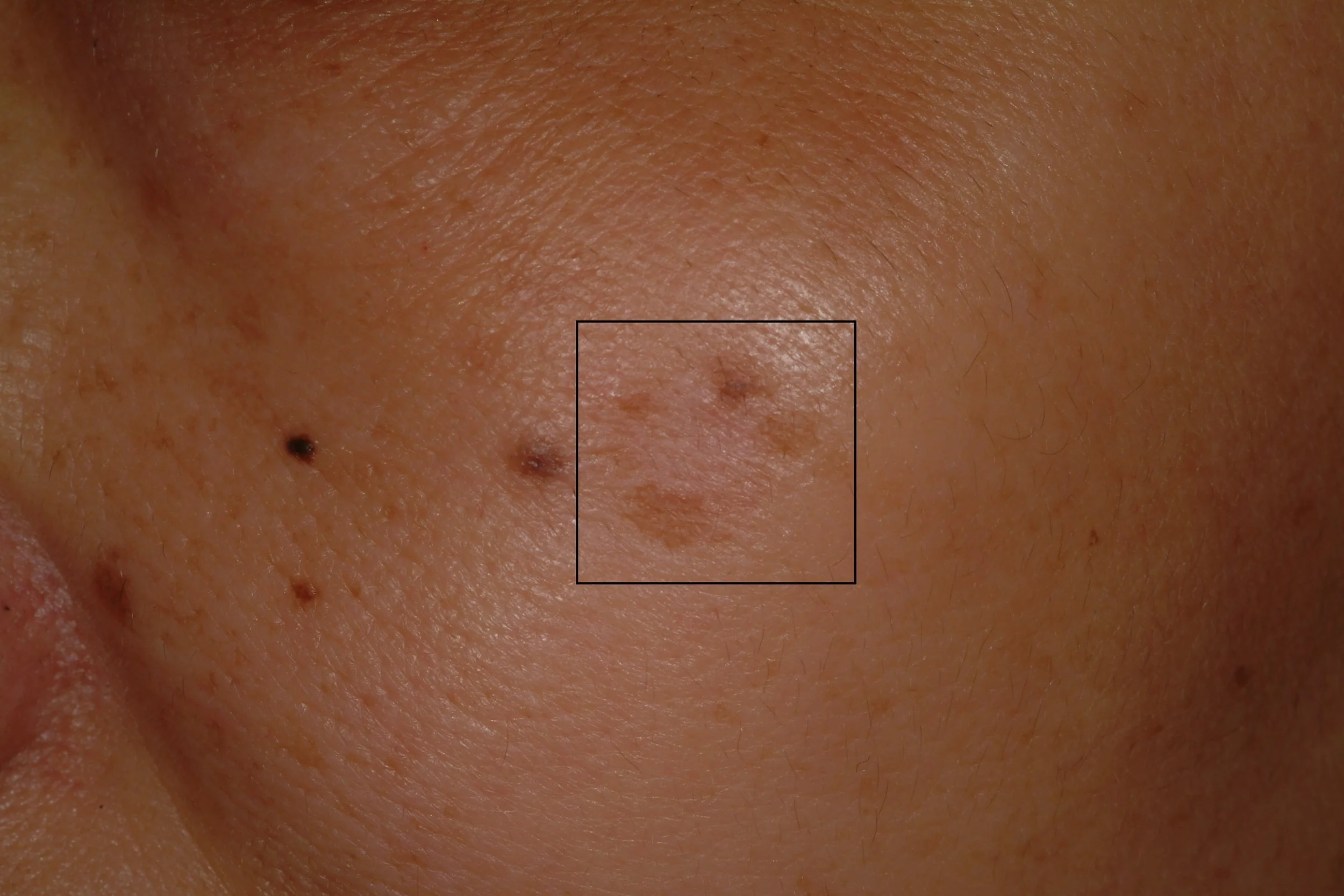 Group of Lentigines (sun spots) on the left cheek before laser treatment