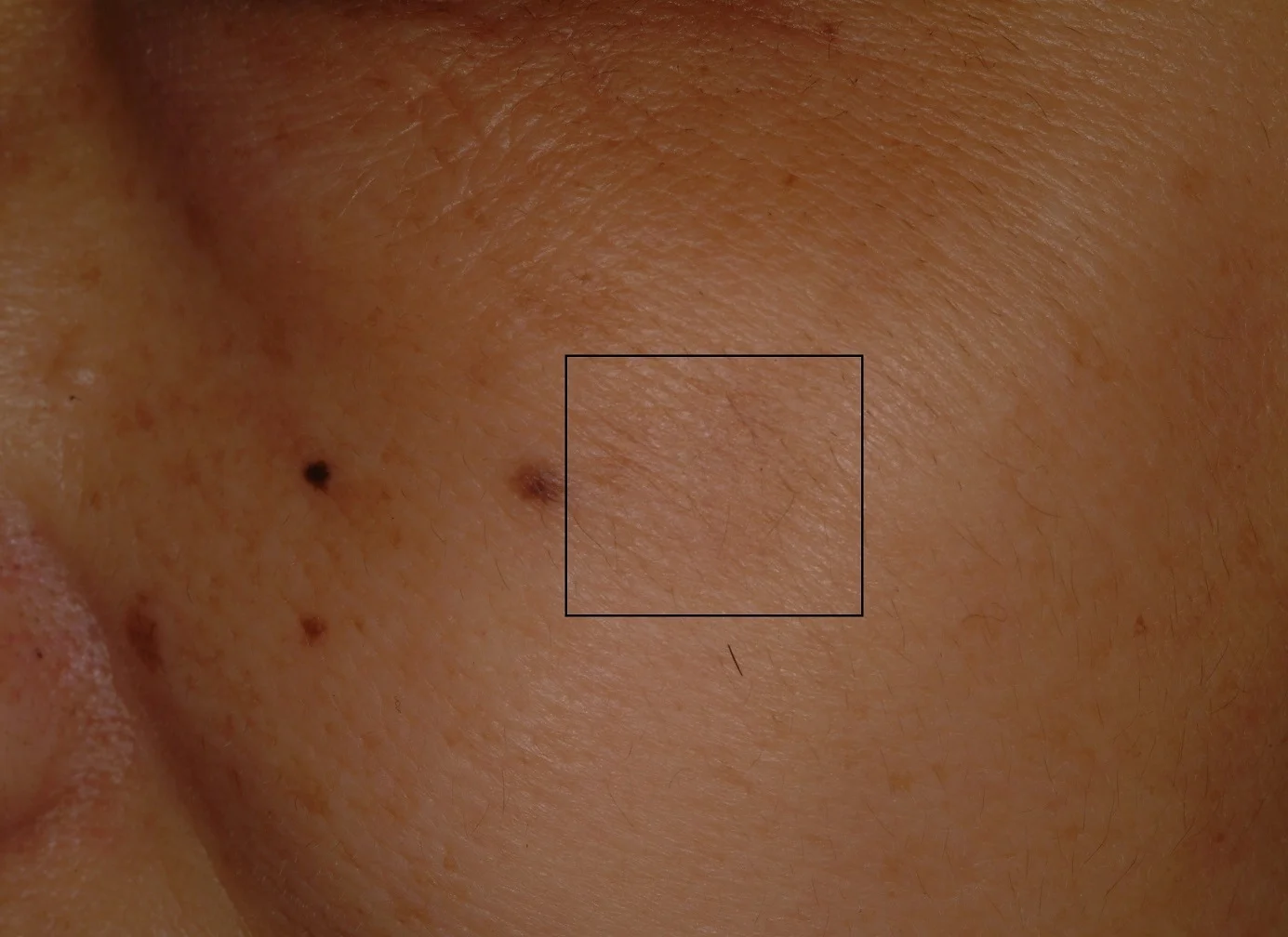 Group of sun spots (in box) after treatment with laser with complete clearance of spots
