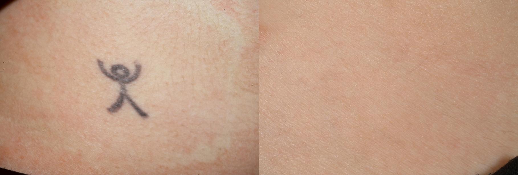 Laser Tattoo Removal What You Need To Know To Get Started