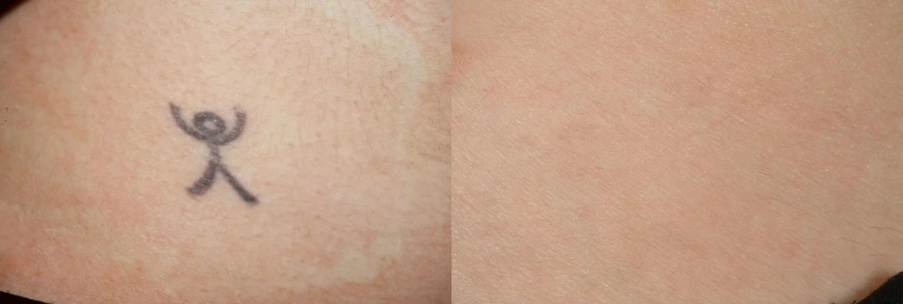 This tattoo is one color with less ink used by the tattoo artist. Therefore this tattoo was able to be completely cleared in 3 sessions with one laser system used.