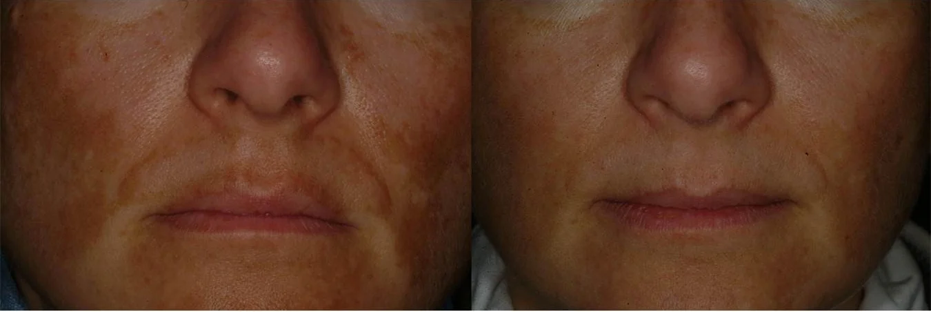 Melasma1.jpg