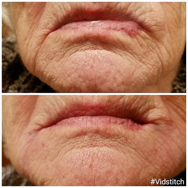 This sweet 95-year-old great-grandmother loves her results after just 1 syringe of Filler to her marionette lines, perioral wrinkles and mental crease.
She says she doesn't look a day over 85! 😁
.
.
.
.
#juvederm #restylane #fillers #filler #chicago