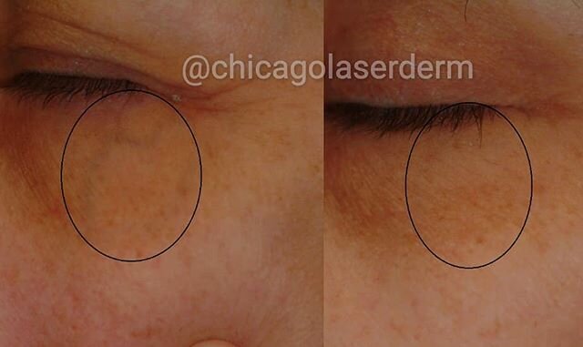 Large blue blood vessels under the eye (called superficial infraorbital veins) are a common issue for patients. These unsightly veins need to be treated very cautiously given their proximity to the eye.
At PLDI, we have multiple lasers that can be us