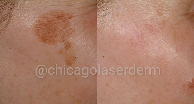 Brown spots, also called lentigines or sun spots, are caused by sun and age. While sunscreen is a must and lightening creams can be helpful, the best treatment remains laser.
This patient underwent Q-switched Ruby laser treatment with excellent resul