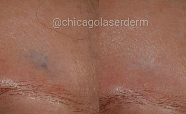 Laser tattoo removal also is useful after a traumatic event. This patient had gravel tattooed into their skin after a bike accident. Typically 1-3 sessions with a laser can effectively clear the skin!
.
.
.
#chicagoderm #dermatology #laser #laserderm