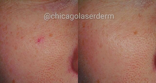 Angiomas are blood vessels growth that can affect anyone at any age. These unsightly red spots can usually be treated with 1-2 laser treatments. 
At PLDI, we have multiple laser systems that can treat red spots, so our dermatologists can choose the c