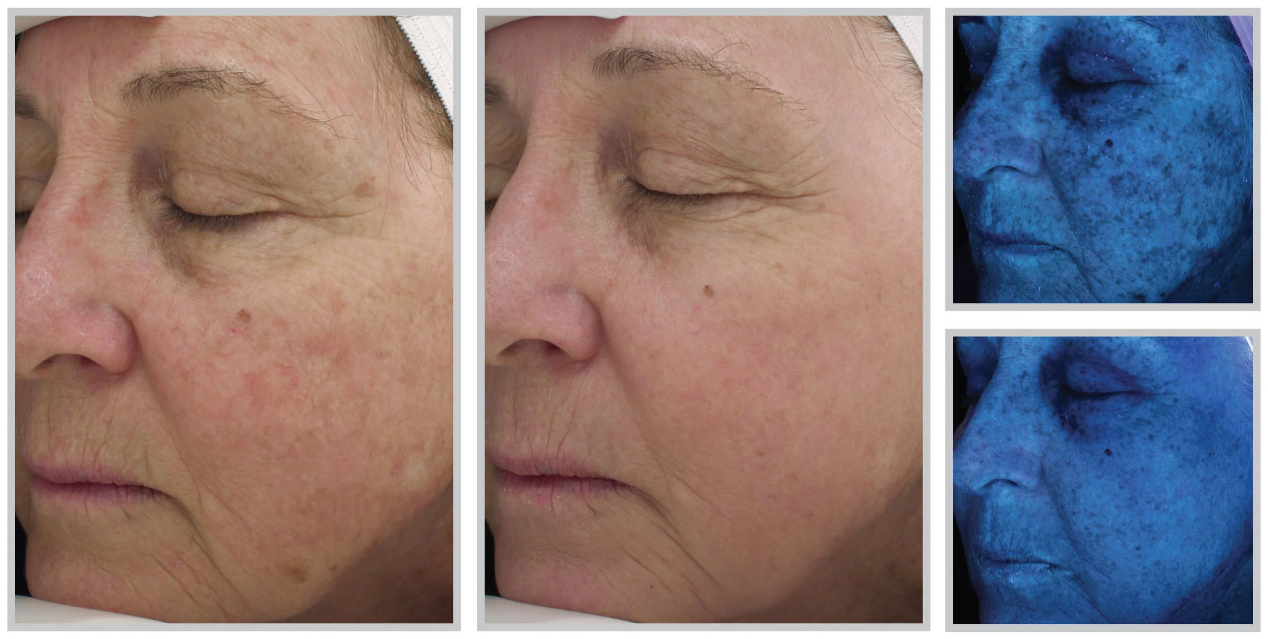 Halo Skin Resurfacing — StrotherDermatology.com