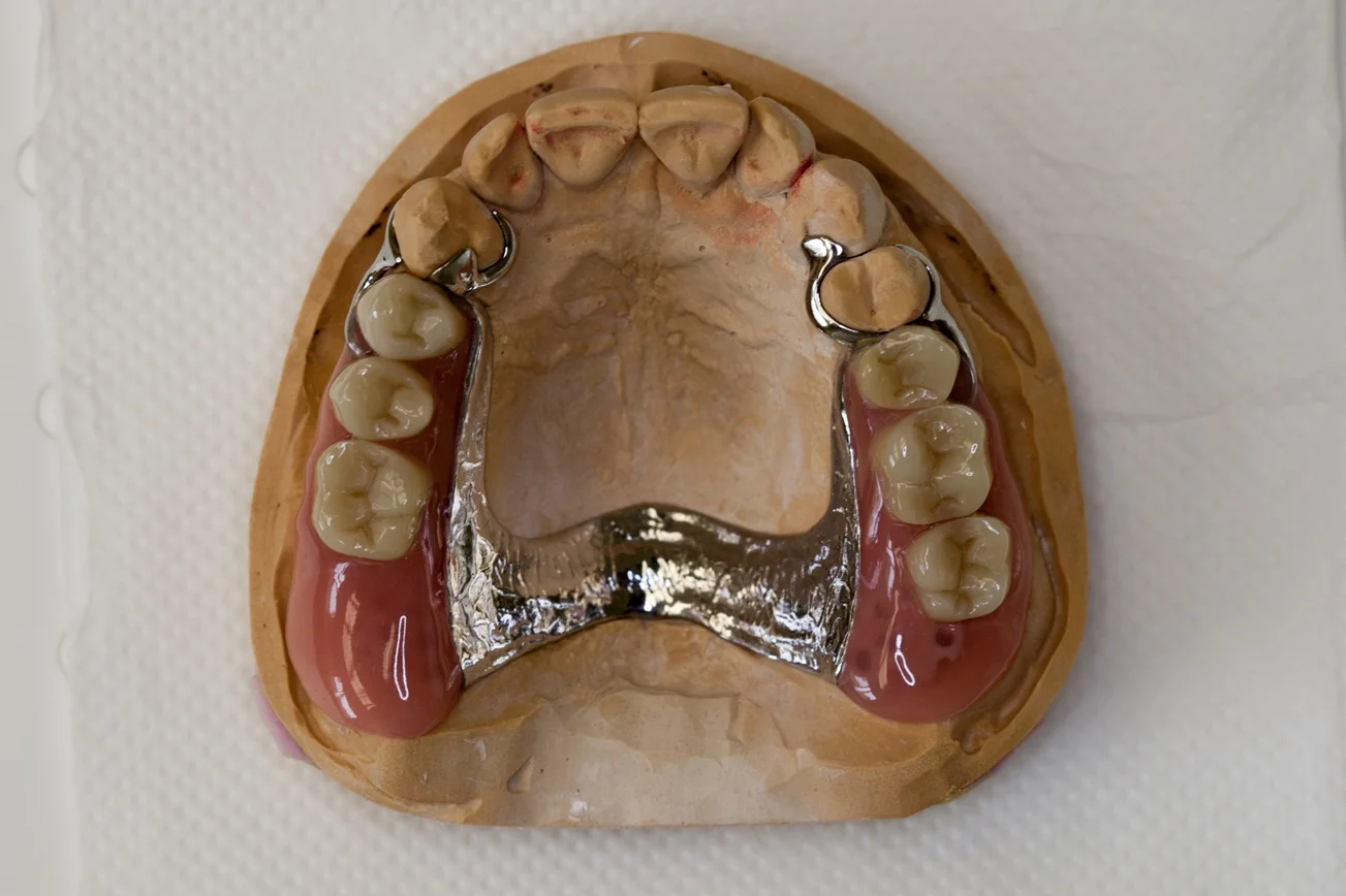 Dentures Seven Hills Dentist Capstone Dental