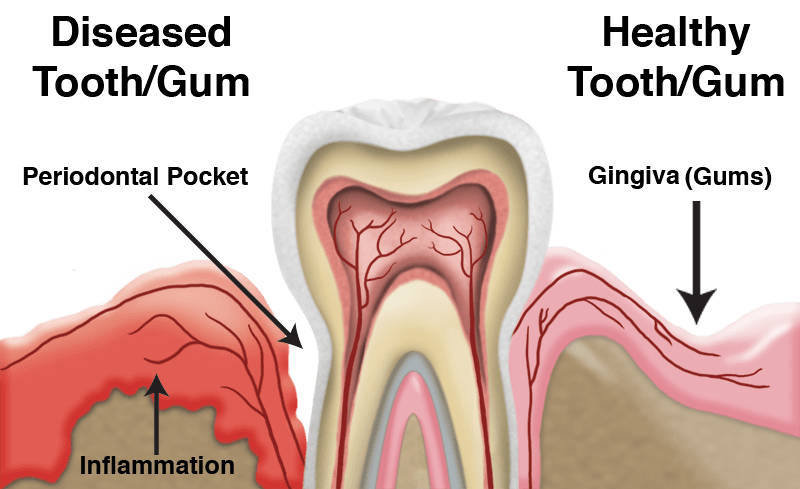 Ask The Dentist Why Do My Gums Bleed Capstone Dental