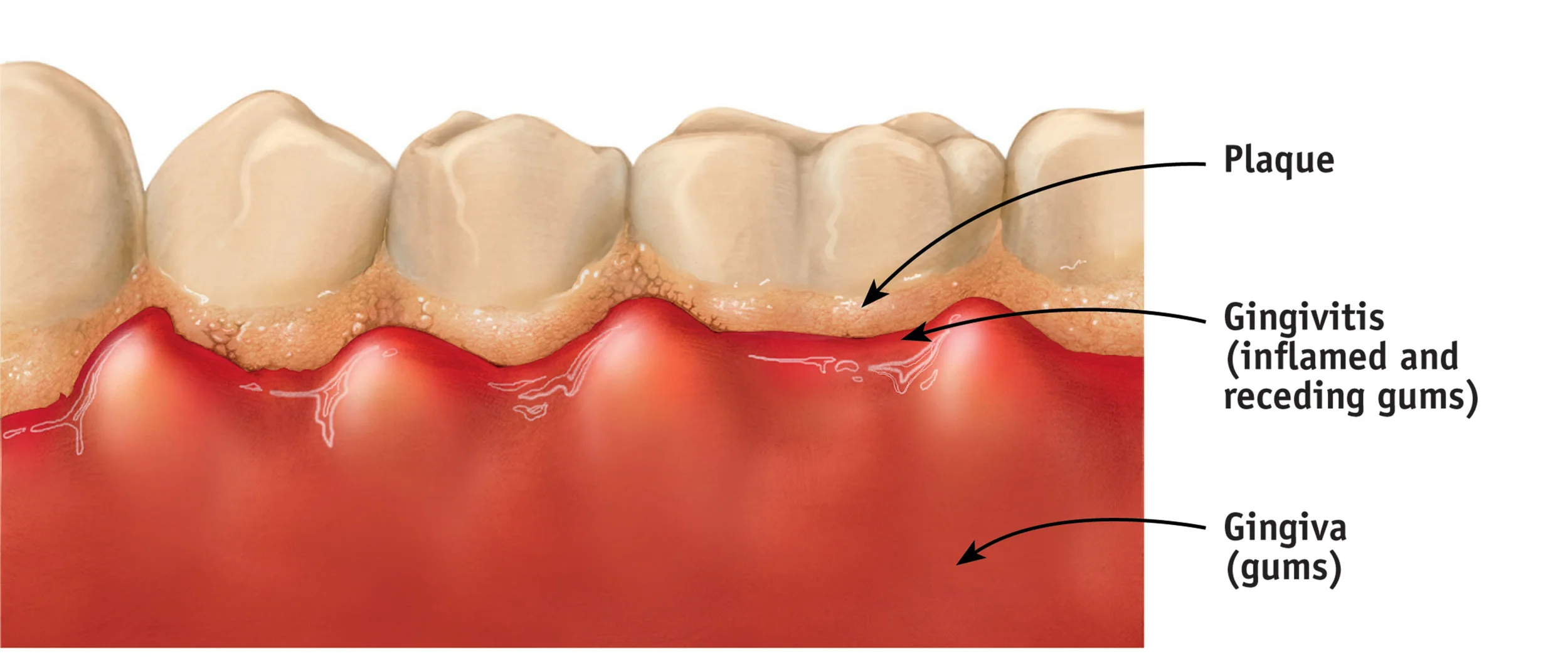 How Does Plaque Build Up On Your Teeth? – IULA