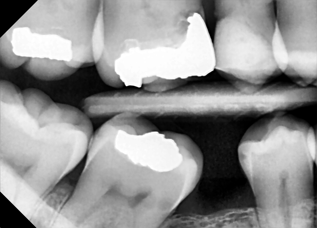 Ask The Dentist What Are Dental X Rays And Are They Safe Capstone