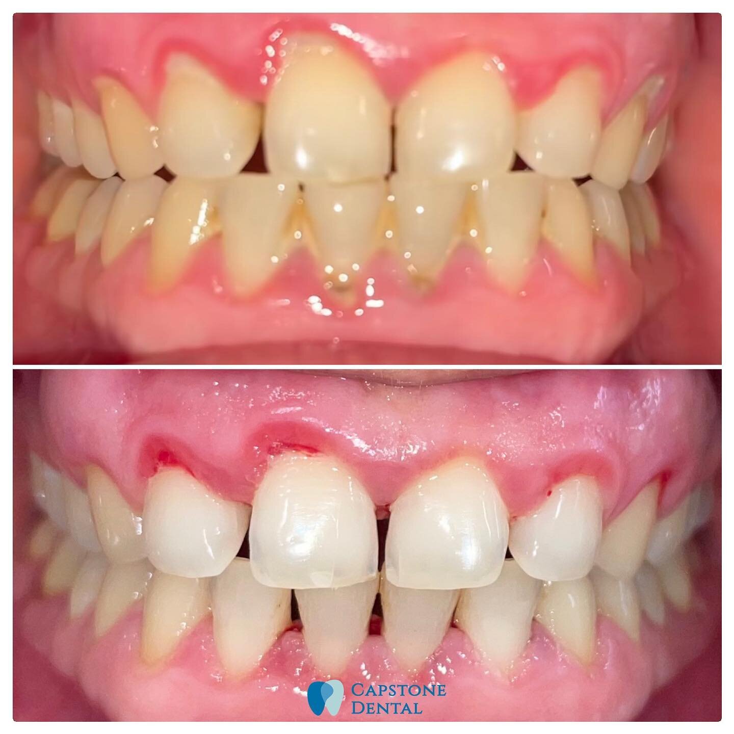 😬Are these results from Teeth Whitening or a Dental Clean? 

Do you have plaque and tartar build up causing your teeth to look dull yellow and dark?

If you haven&rsquo;t had a dental clean for more than 12 months or 12 years, this is what your teet