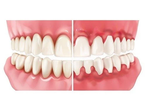 Why is Vitamin D important for the health of your teeth and gums?