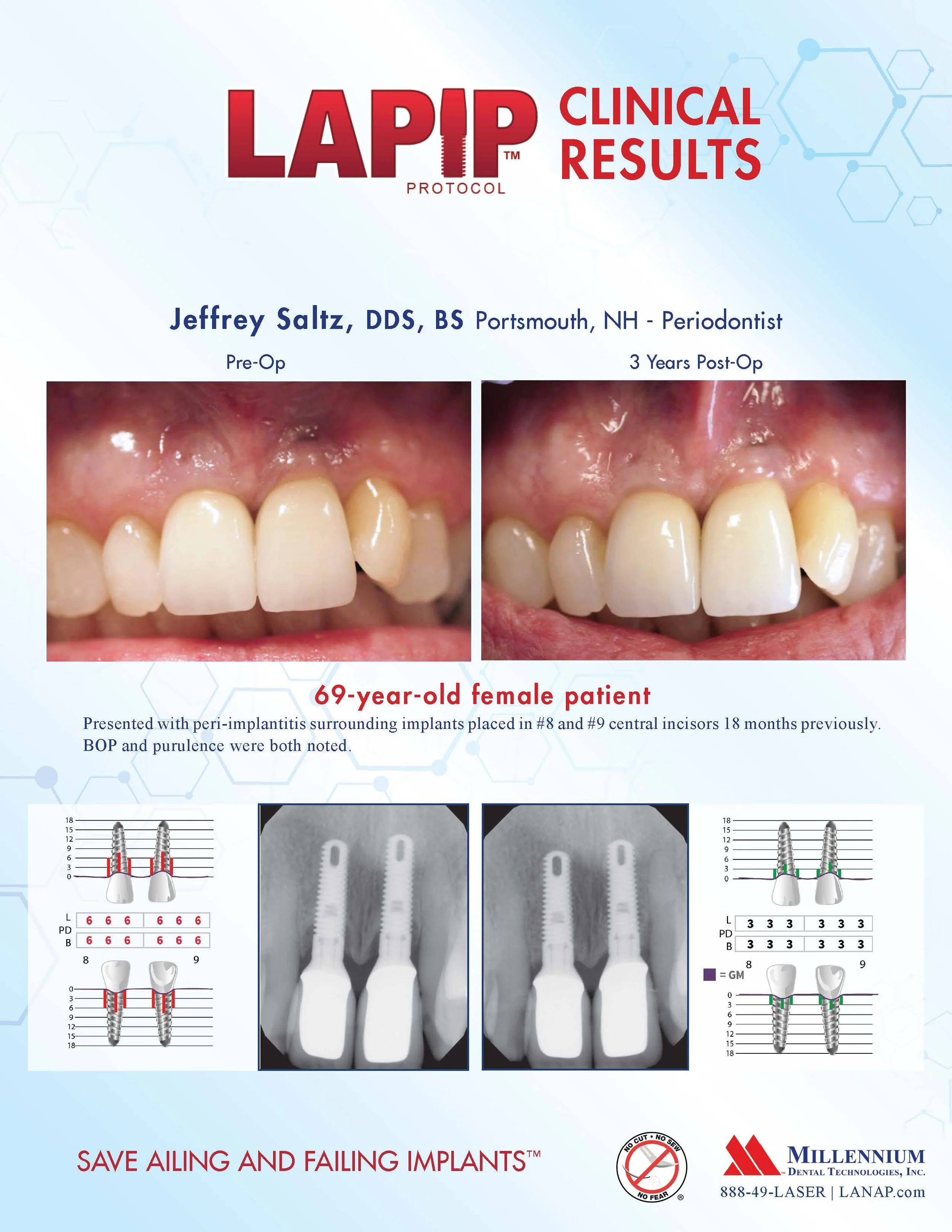 LANAP mailer 8.5x11 v30-_Page_07.jpg