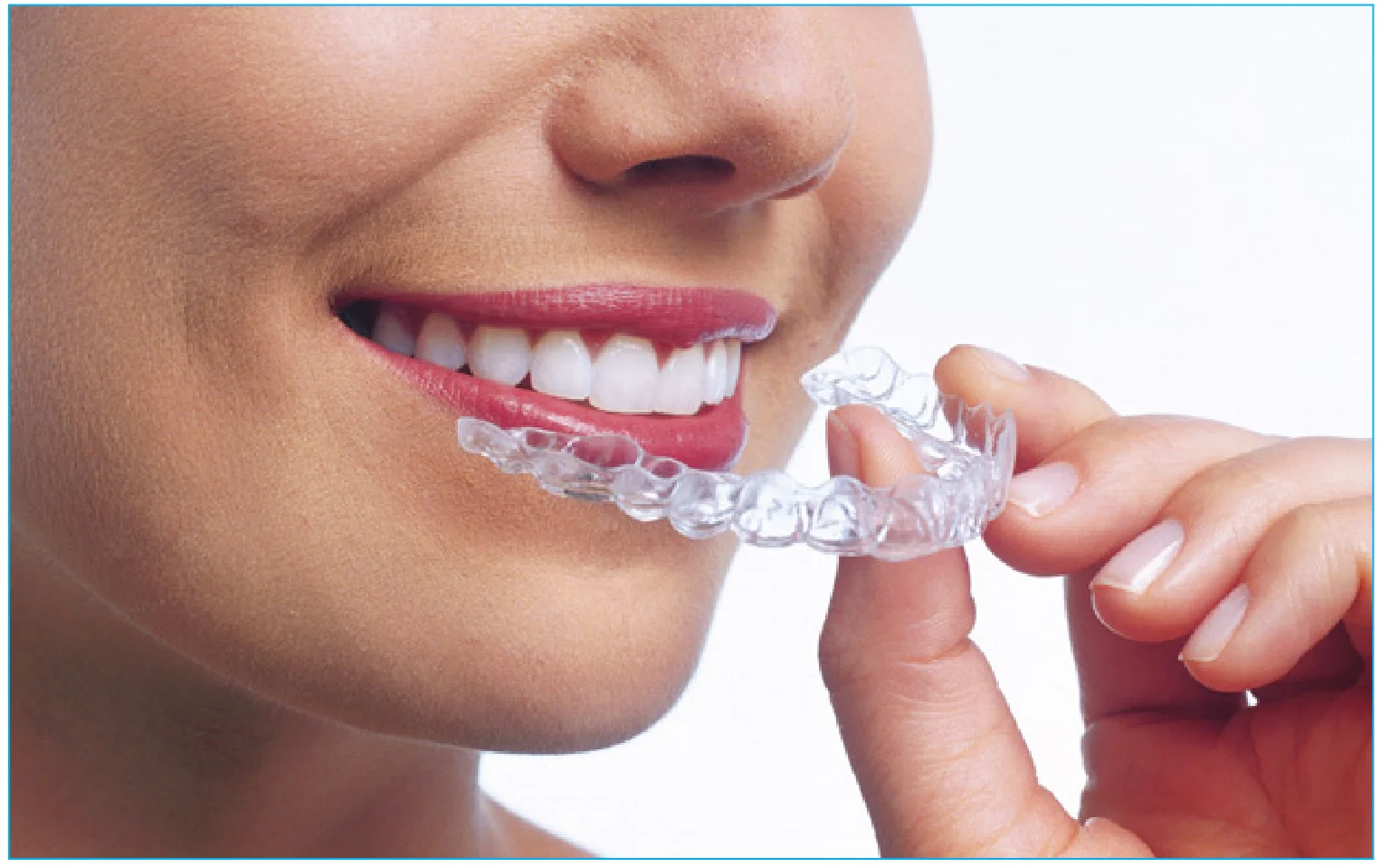 Clear20Aligners.jpg