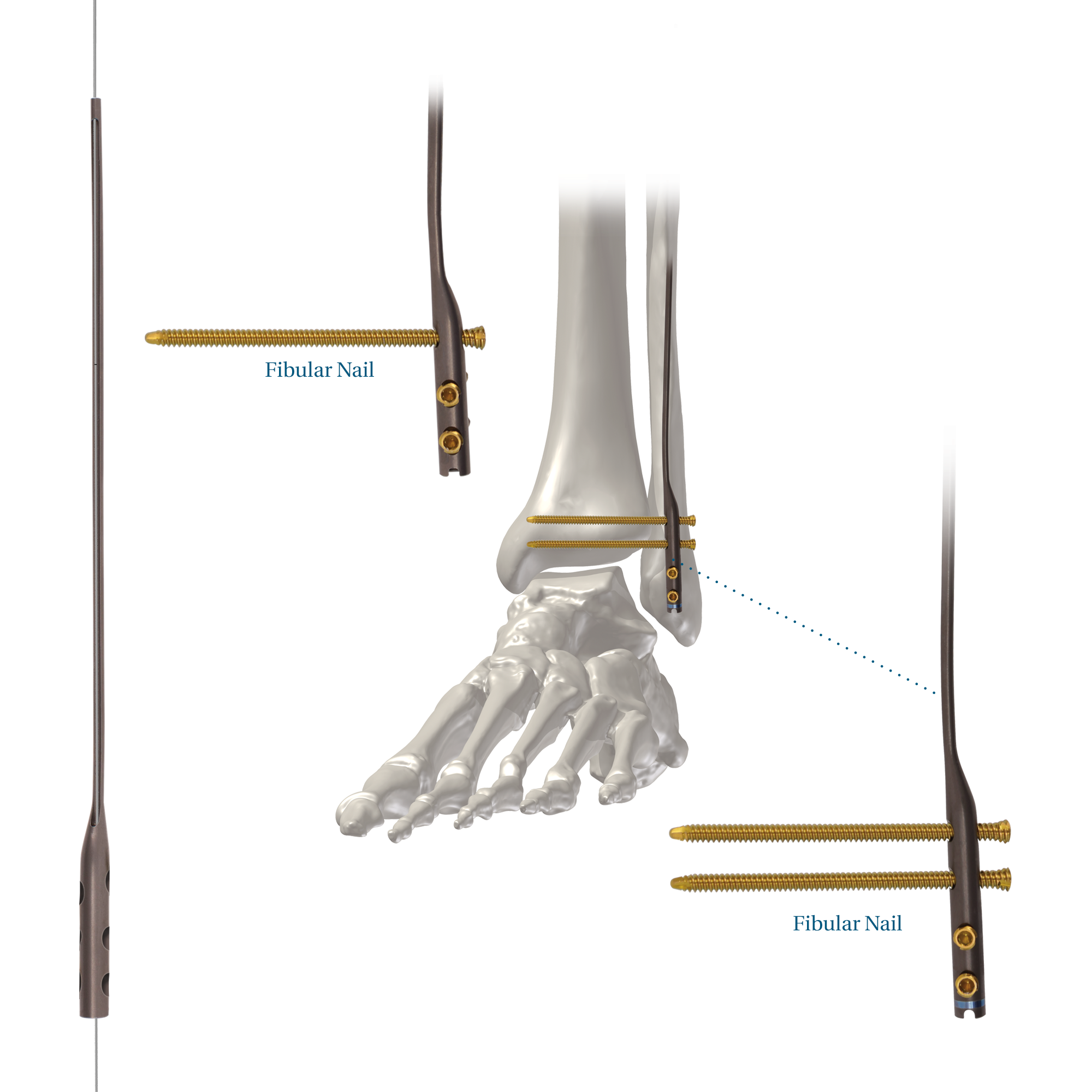 Titanium Cannulated Tibial Nail-EX | DePuy Synthes | J&J MedTech US