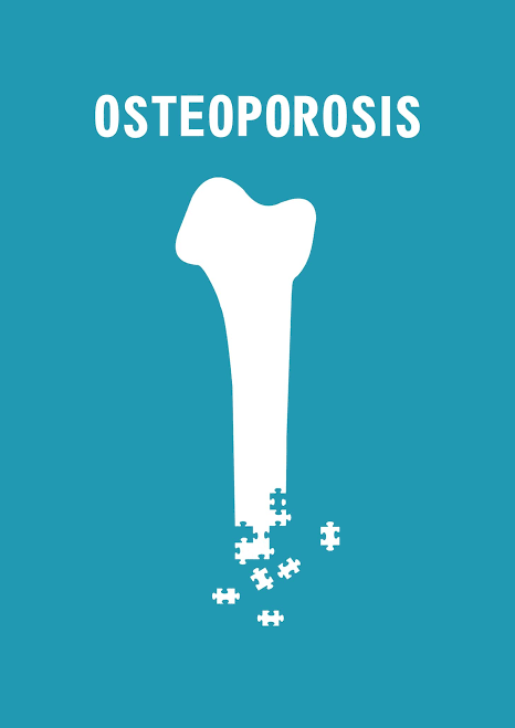 Bone Health Basics: Preventing Osteoporosis More than 6 million Aussies over 50 have osteoporosis or poor bone health. 