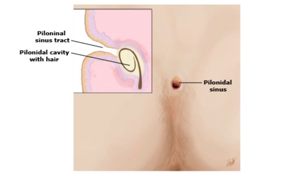 Pilonidal sinus Symptoms pictures and treatment