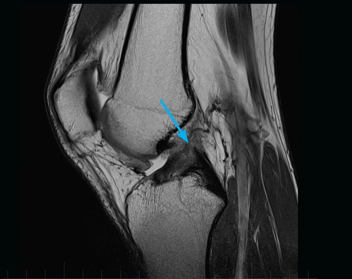 MRI of a patient's knee showing a complete rupture of the Anterior Cruciate Ligament (ACL).