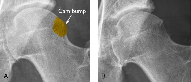 AP Radiographs of the left hip illustrating a CAM lesion (A) pre- and (B) post-resection.