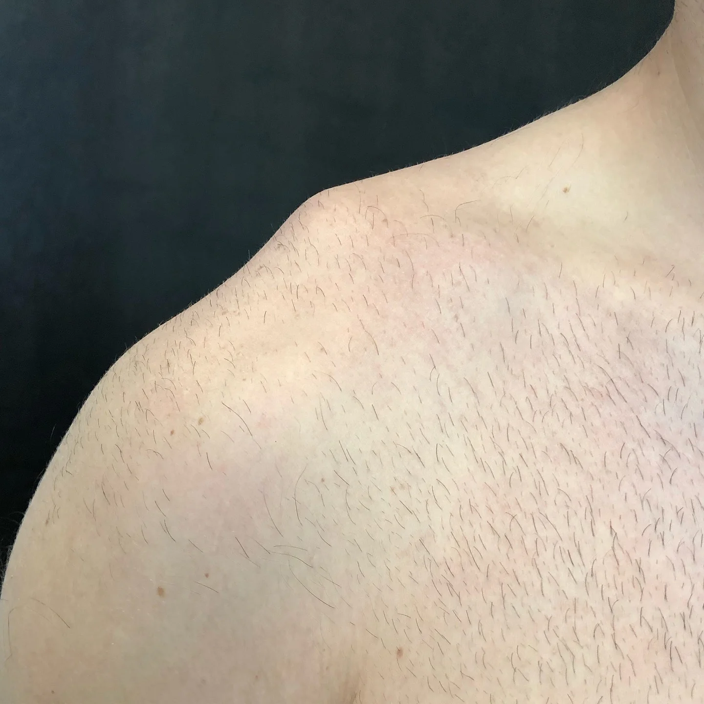 Acromioclavicular (AC) Joint Separations — Andrew Dold, MD Orthopedic