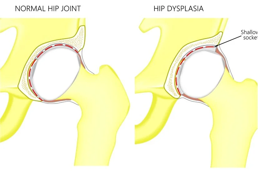Hip Dysplasia — Frisco Texas Orthopedic Surgeon and Sports Medicine